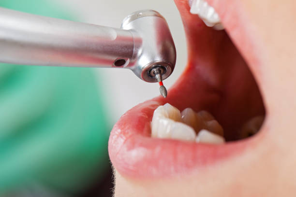 Best Emergency Dentist for Lost Fillings or Crowns in Pecatonica, IL